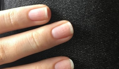 Co znaczą białe zmiany na paznokciach? Nie musi być to powód do obaw