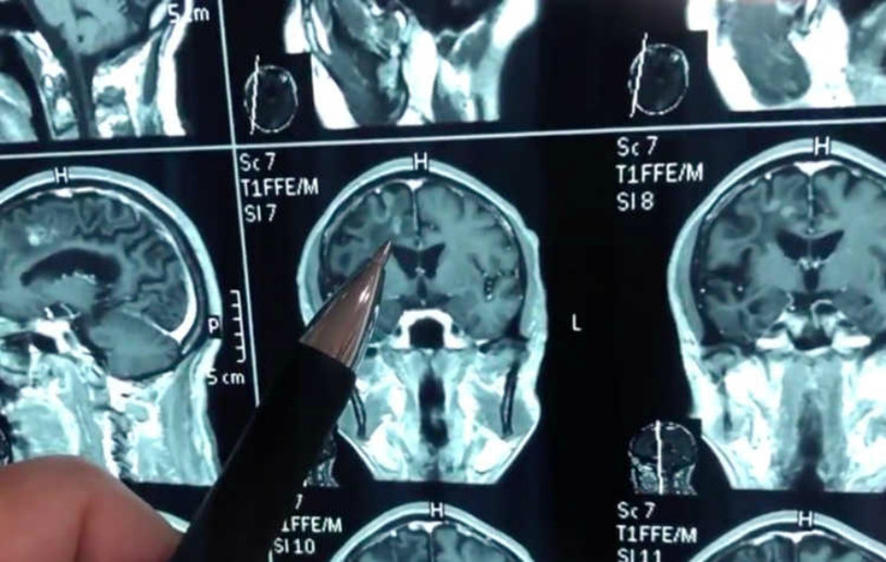 Co znajdowało się w mózgu skarżącego się na bóle głowy mężczyzny? /YouTube