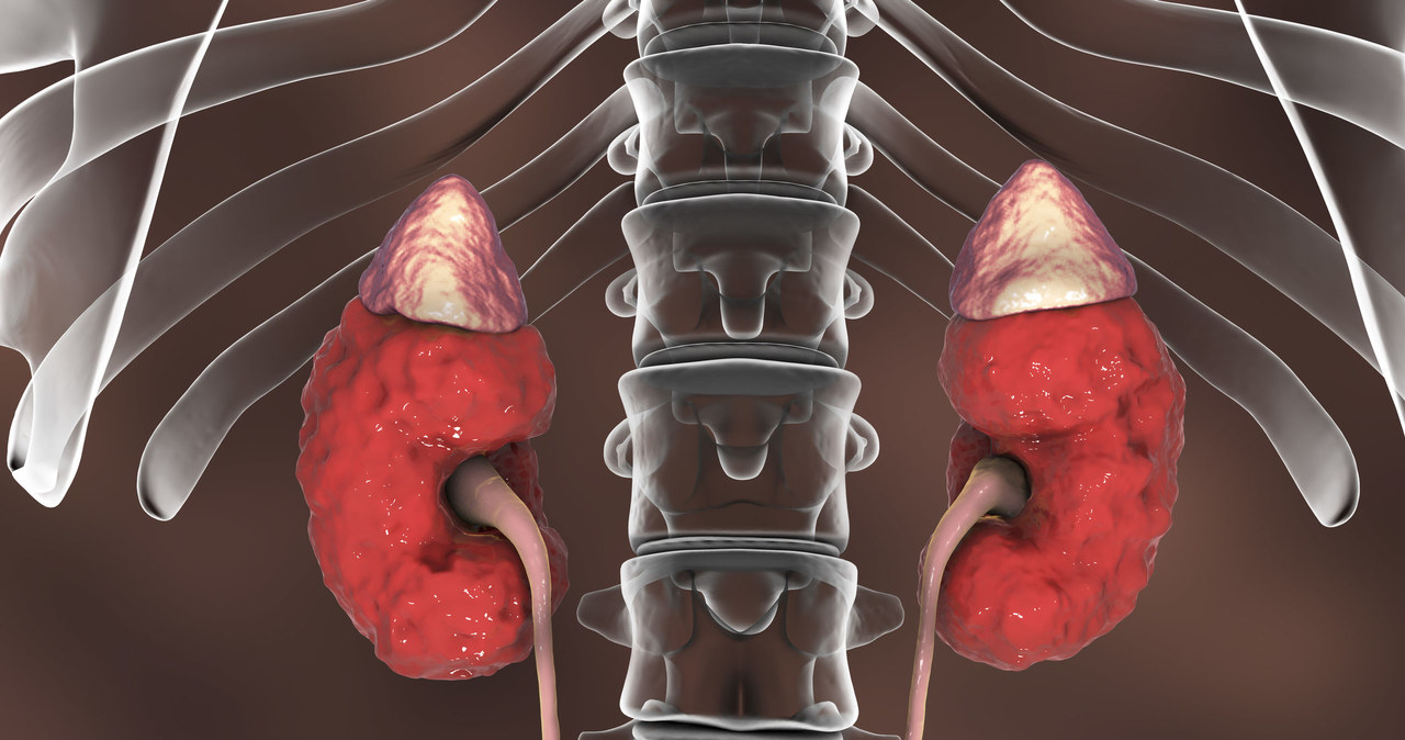 Coraz bliżej pokonania przewlekłej choroby nerek /123RF/PICSEL