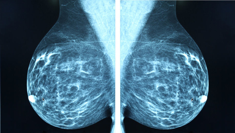 Coraz bliżej pokonania raka piersi? Wystarczy tylko 11 dni! /123RF/PICSEL