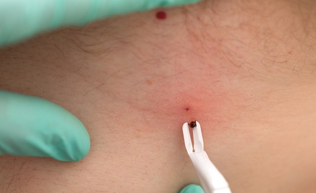 ​Coraz więcej przypadków boreliozy. Znamy najnowsze dane