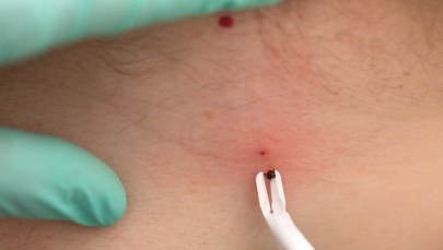 ​Coraz więcej przypadków boreliozy. Znamy najnowsze dane