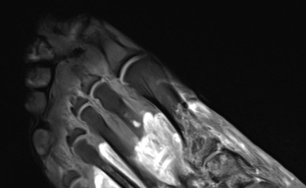 Covid może sprawić, że nasz organizm sam się zaatakuje