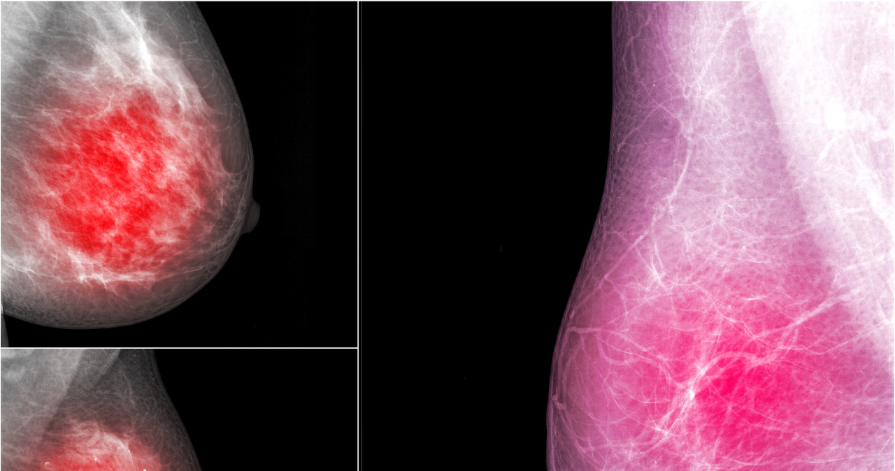 Czasami guz jest niewyczuwalny, a sygnałem, że się jest nie tak, może być zagłębienie w piersi lub zmiany na jej skórze /123RF/PICSEL