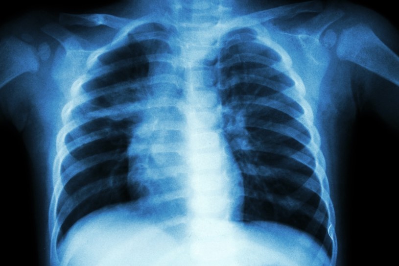 Czasami stan zapalny płuc może wynikać z nadwagi /123RF/PICSEL