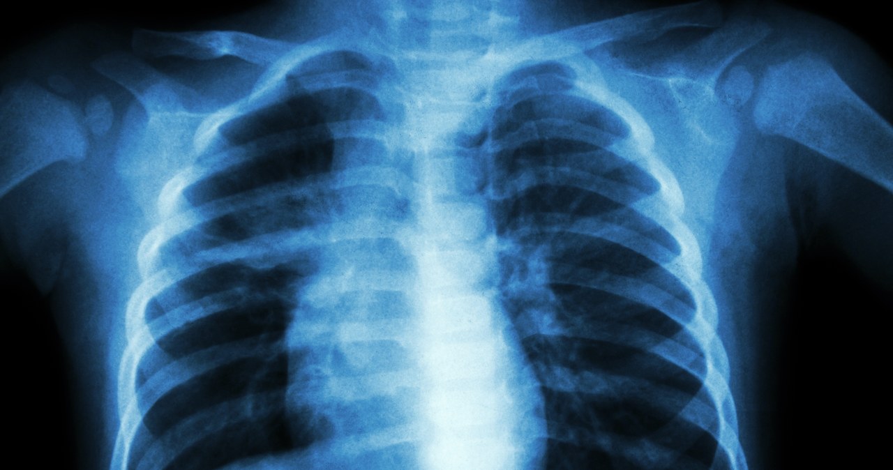 Czasami stan zapalny płuc może wynikać z nadwagi /123RF/PICSEL