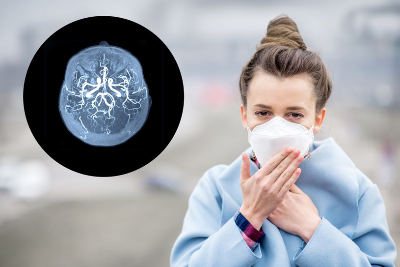 Cząsteczki smogu wraz z krwią wędrują z płuc do mózgu i zostają tam dłużej, niż w innych narządach - odkryli naukowcy /123RF/PICSEL