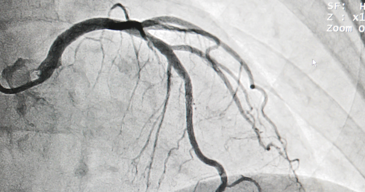 Czeka cię koronarografia? Sprawdź, jak się przygotować /123RF/PICSEL