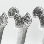 Czeka nas rewolucja w leczeniu osteoporozy? Pomoże wynalazek polskich naukowców