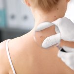 Czerniak - jeden z najgroźniejszych nowotworów złośliwych. Kto w grupie ryzyka?