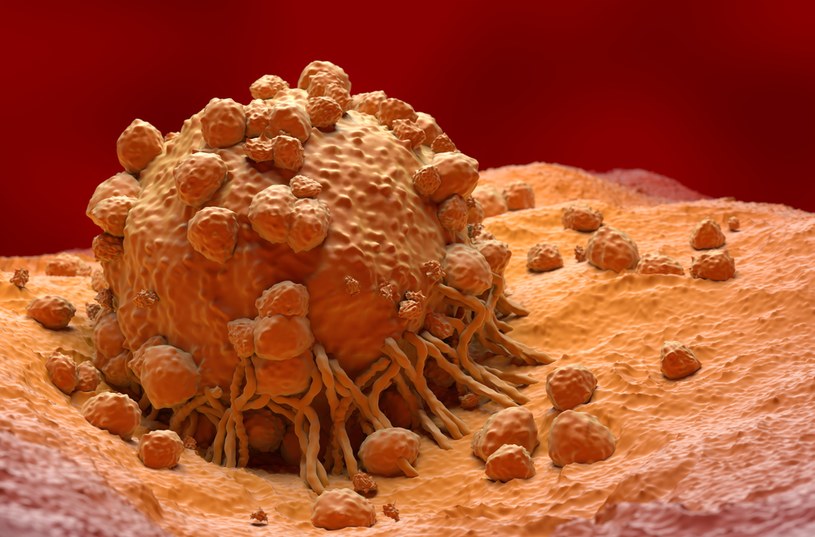 Czerniak jest najniebezpieczniejszym nowotworem spośród wszystkich nowotworów skóry i jednym z najgroźniejszych nowotworów w ogóle /123RF/PICSEL