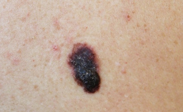 ​Czerniak. Kto jest szczególnie narażony?