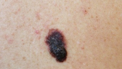 ​Czerniak. Kto jest szczególnie narażony?