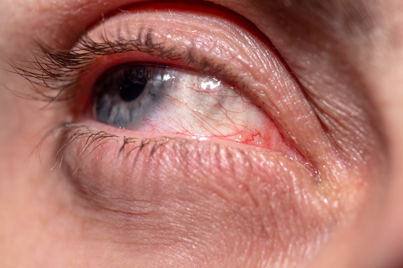 Czerniak oka to rzadki nowotwór złośliwy, ale spośród nowotworów narządu wzroku jest najczęściej diagnozowany /123RF/PICSEL