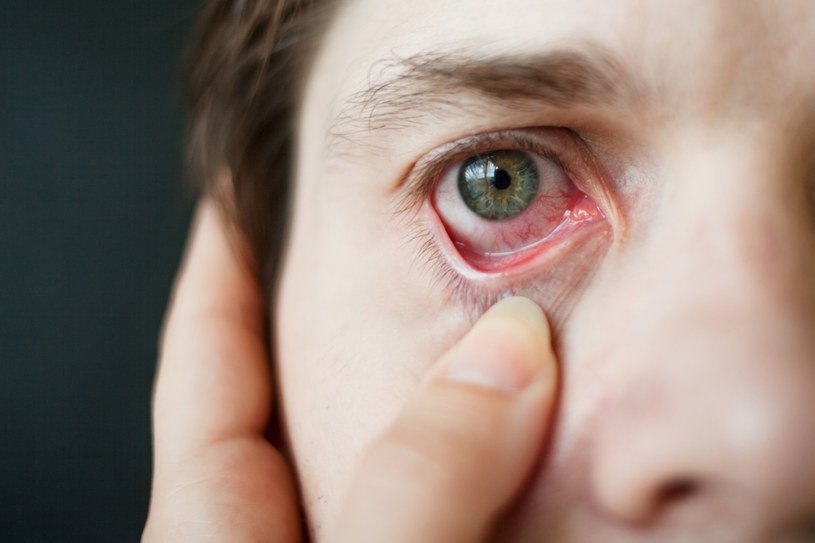 Czerniak oka wykrywany jest zwykle przypadkiem, w późnym i trudnym do leczenia stadium /123RF/PICSEL