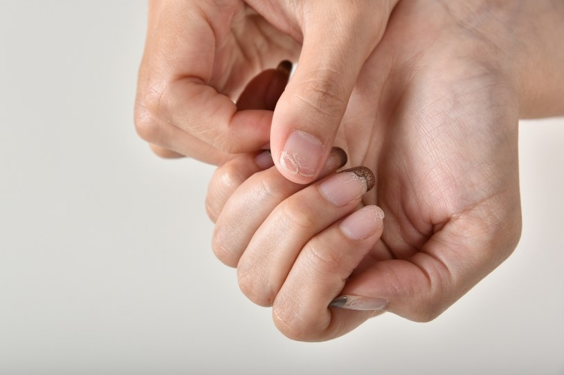 Czerniak paznokcia jest jednym z najtrudniejszych diagnostycznie nowotworów. Jakie objawy na niego wskazują? /123RF/PICSEL