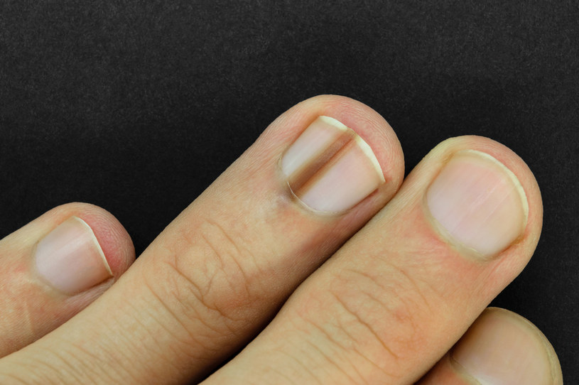 Czerniak paznokcia jest trudny do zidentyfikowania. Można go pomylić ze zwyczajnym urazem /123RF/PICSEL