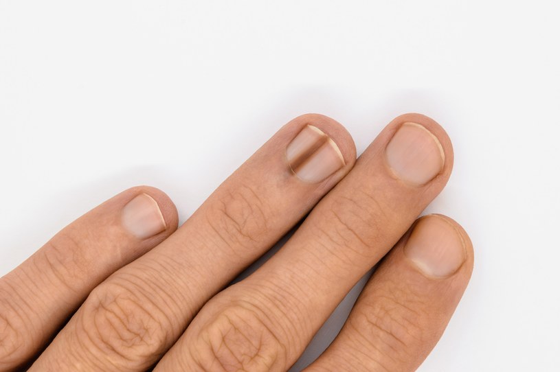 Czerniak paznokcia jest złośliwą chorobą nowotworową, która wbrew pozorom nie daje wielu specyficznych objawów /123RF/PICSEL
