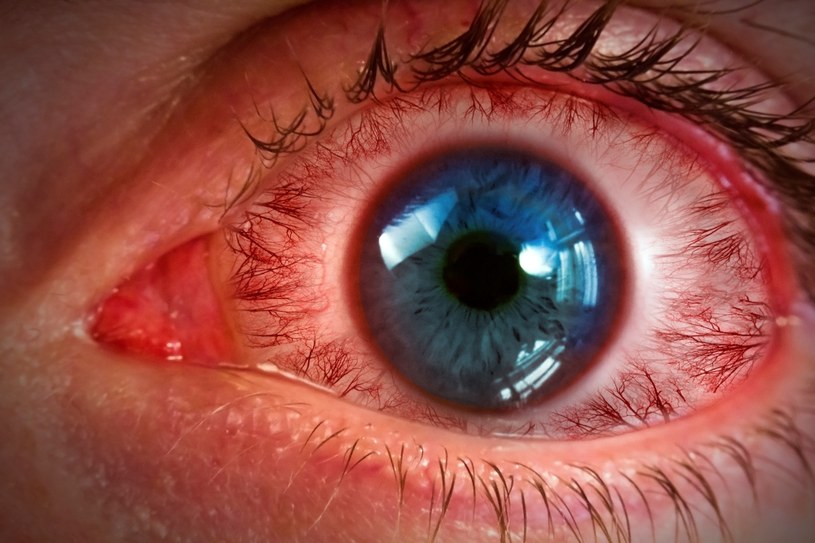 Czerniak w oku to nowotwór oka powstający z komórek barwnikowych, czyli melanocytów /123RF/PICSEL