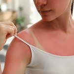Czerwona i piekąca skóra po opalaniu? Weź to z kuchni i zapomnij o bólu