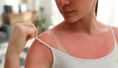 Czerwona i piekąca skóra po opalaniu? Weź to z kuchni i zapomnij o bólu