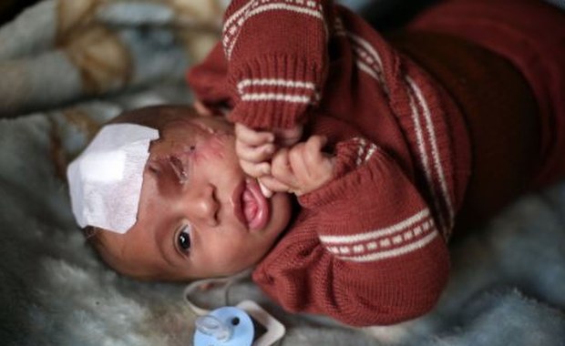 Częściowo oślepione dziecko symbolem cierpień mieszkańców Wschodniej Ghuty