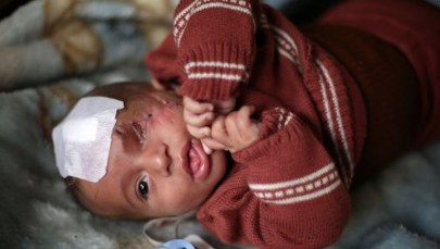 Częściowo oślepione dziecko symbolem cierpień mieszkańców Wschodniej Ghuty