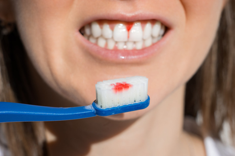 Częste krwawienia podczas mycia zębów lub po skaleczeniu są wskazaniem do oznaczenia poziomu płytek krwi w morfologii /123RF/PICSEL