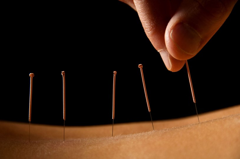 Czy akupunktura to rzeczywiście lek na wszystko? /123RF/PICSEL