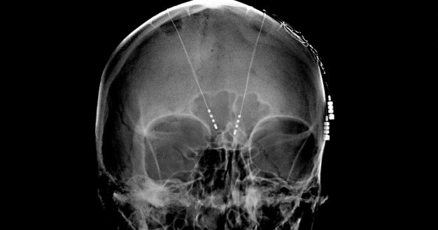 Czy kiedyś implanty w mózgu przywrócą pamięć osobach po udarach i wypadkach? /materiały prasowe