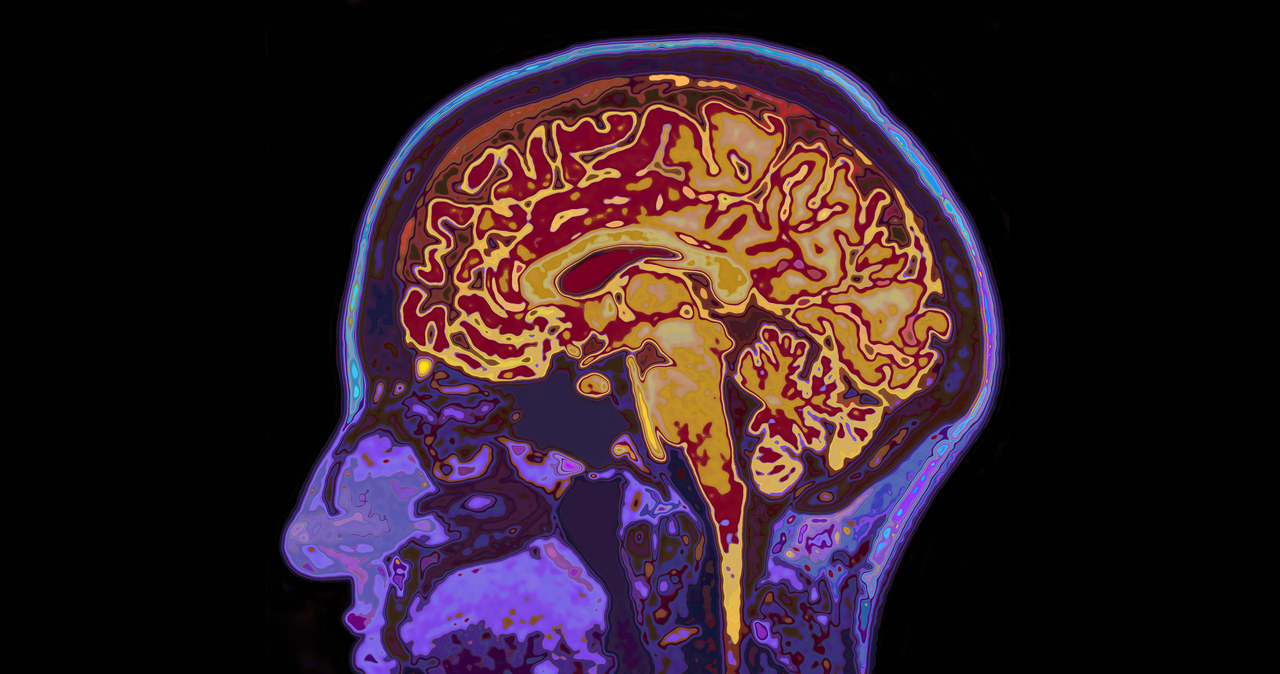 Czy komórki po udarze mózgu da się naprawić? /123RF/PICSEL