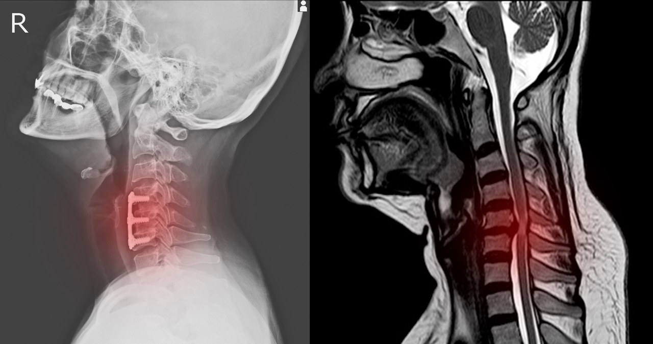 Czy można naprawić uszkodzony rdzeń kręgowy? /123RF/PICSEL