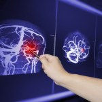 Czy to guz mózgu? Nie ignoruj tych sygnałów