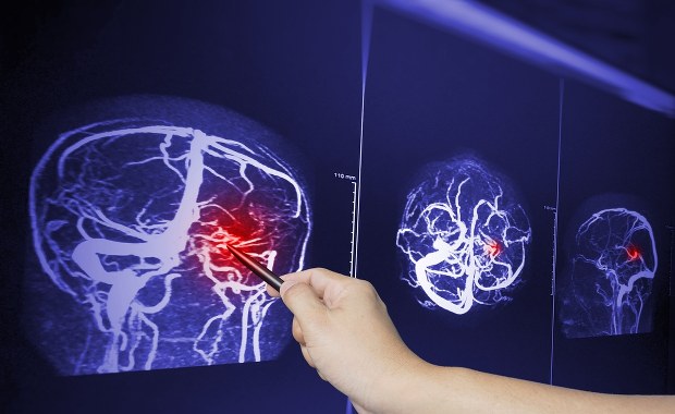 Czy to guz mózgu? Nie ignoruj tych sygnałów