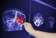 Czy to guz mózgu? Nie ignoruj tych sygnałów