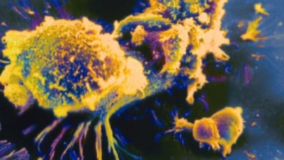 Czy to medyczny przełom? Naukowcy o "nadzwyczajnym sukcesie" nowej metody leczenia raka