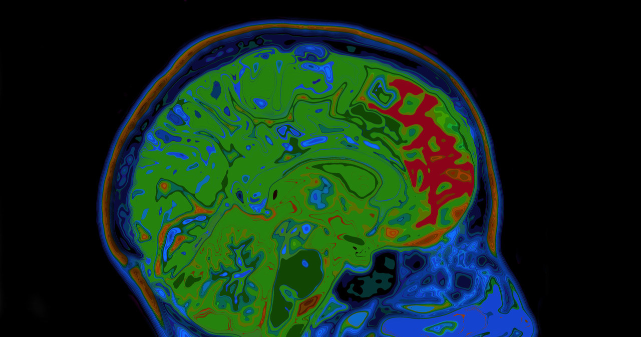 Czy u osób z COVID-19 mogą występować powikłania neurologiczne? /123RF/PICSEL