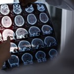 Czy witamina D może chronić mózg przed chorobą Alzheimera? Nowe badania dają nadzieję