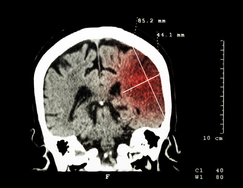 Czy wkrótce uda się ocalić pacjentów po udarze mózgu? /123RF/PICSEL