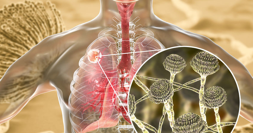 Czym jest grzybica płuc i jak się objawia? /&copy;123RF/PICSEL