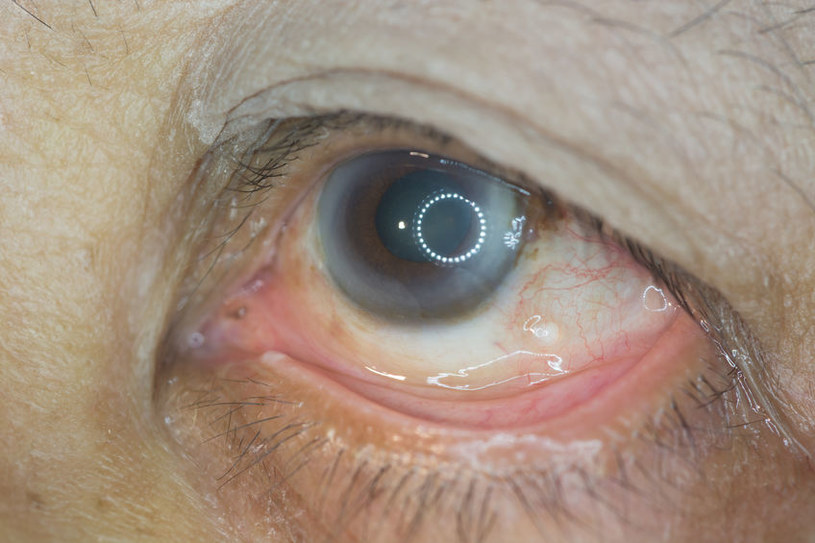 Czym jest retinopatia cukrzycowa i jak się objawia? /&copy;123RF/PICSEL