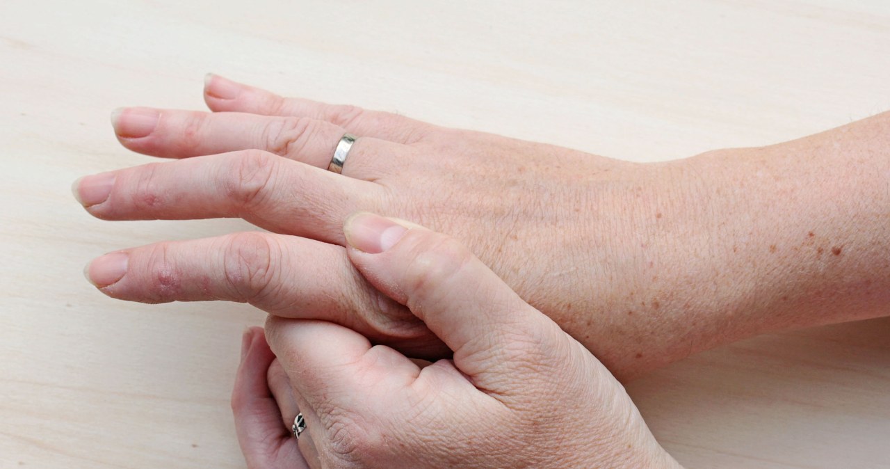 Czym smarować dłonie, by pozbyć się plamek i przebarwień? /123RF/PICSEL