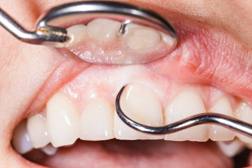 Dbaj o zęby regularnie /123RF/PICSEL