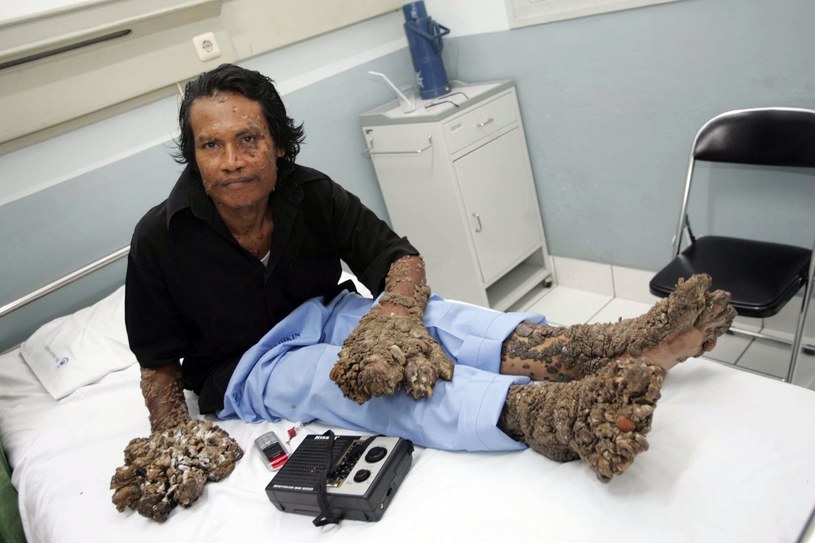 Dede Koswara - jego kończyny przypominają swoim wyglądem zdrewniałe gałęzie /AFP