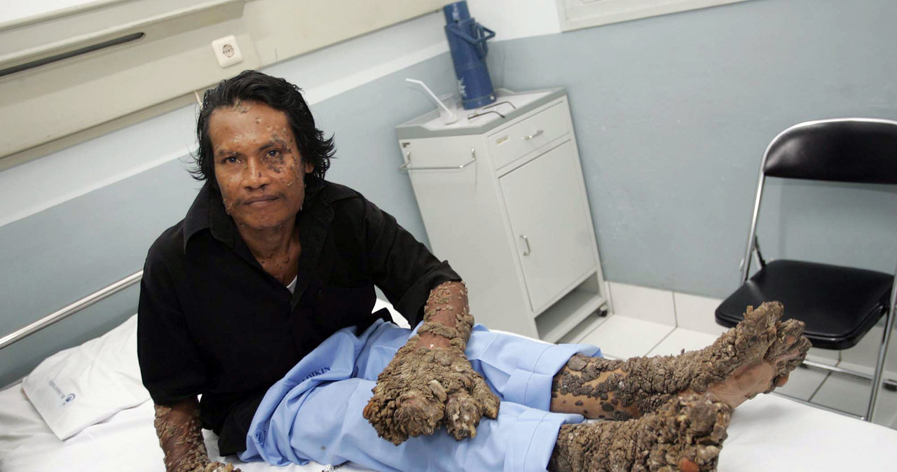 Dede Koswara - jego kończyny przypominają swoim wyglądem zdrewniałe gałęzie /AFP