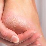 Dermatolodzy radzą, jak dbać o stopy jesienią 