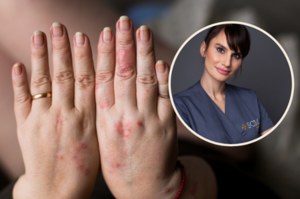 Dermatolog wylicza produkty, które szkodzą skórze z problemami. Pięć jest najgorszych