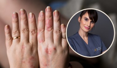 Dermatolog wylicza produkty, które szkodzą skórze z problemami. Pięć jest najgorszych