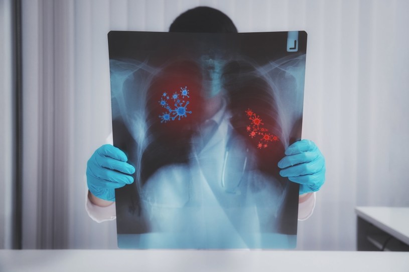 Diagnostyka grzybicy płuc wymaga badań obrazowych i pobrania wymazu do badań /123RF/PICSEL