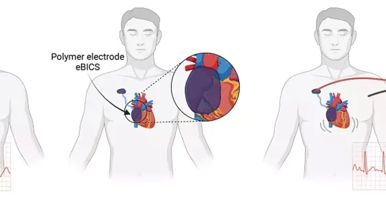 Diagram ilustrujący, jak działa nowy wstrzykiwany rozrusznik serca /Lund University/biorender.com /domena publiczna